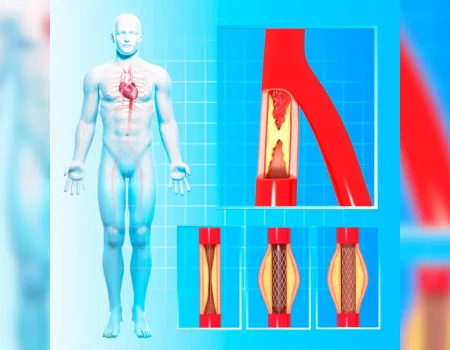 Percutaneous Balloon valvuloplasty