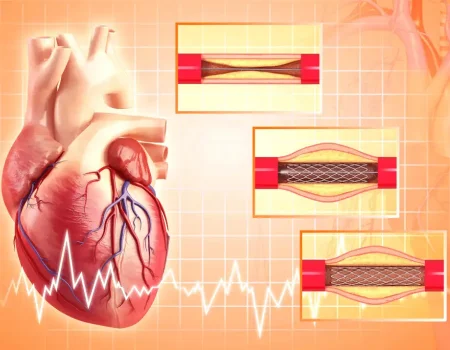 Angiogram and Angioplasty