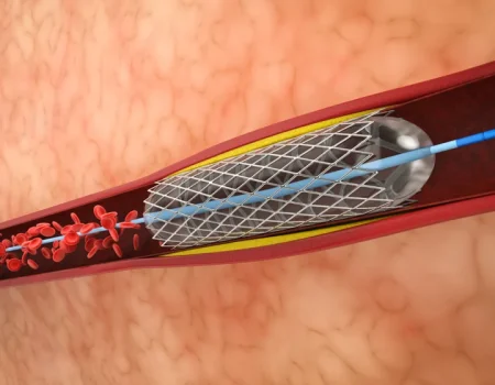 Peripheral-Angioplasty