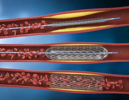 3d-rendering-balloon-angioplasty-procedure-with-stent-vein_1_1200x800